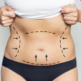 Liposuction in Novi