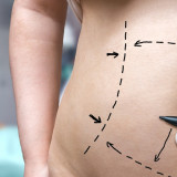 Liposuction vs. Tummy Tuck