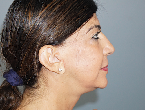Case #557 After image