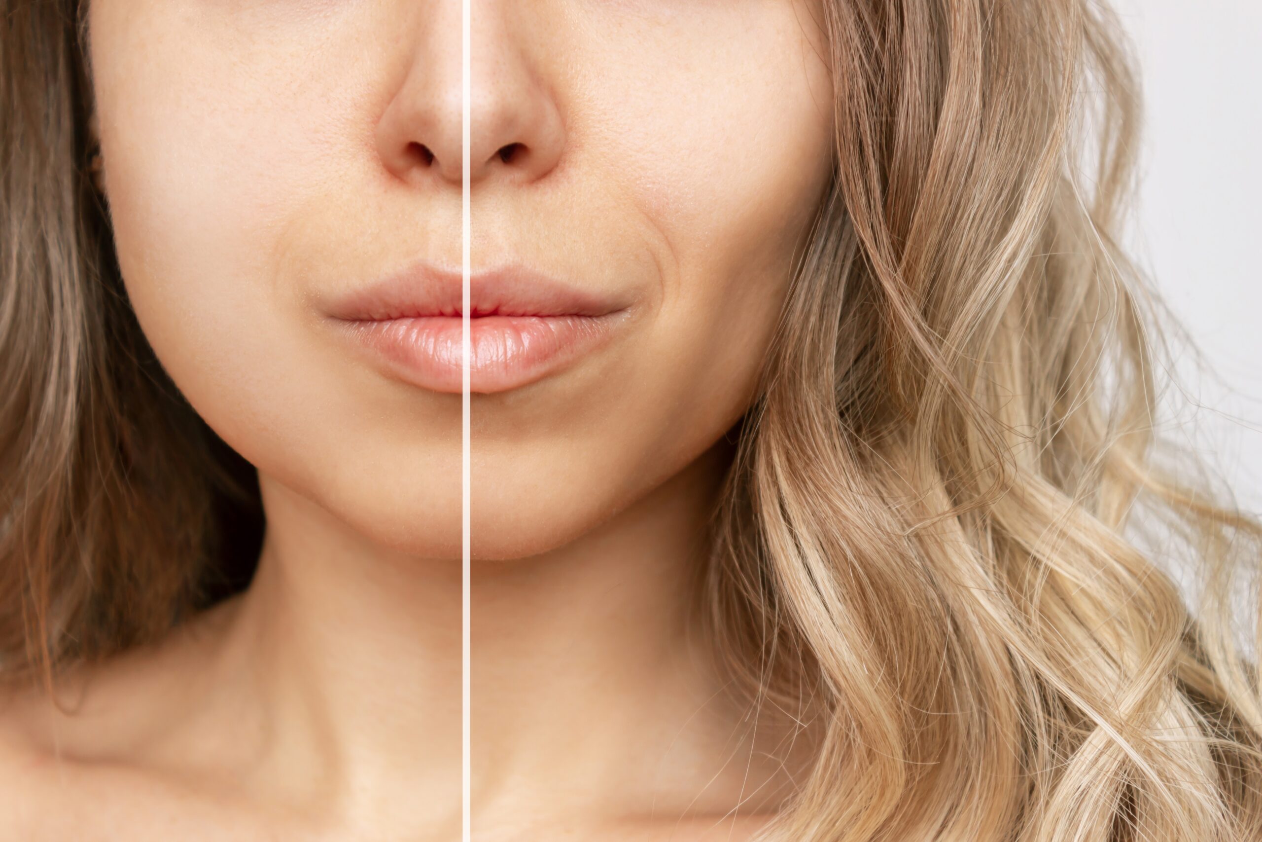 What Does the Buccal Fat Removal Process Entail?