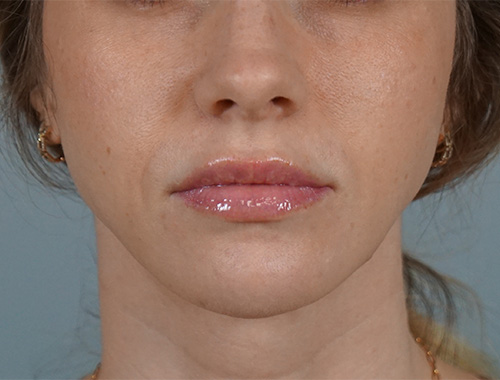 Case #666 After image