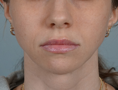 Case #666 Before image