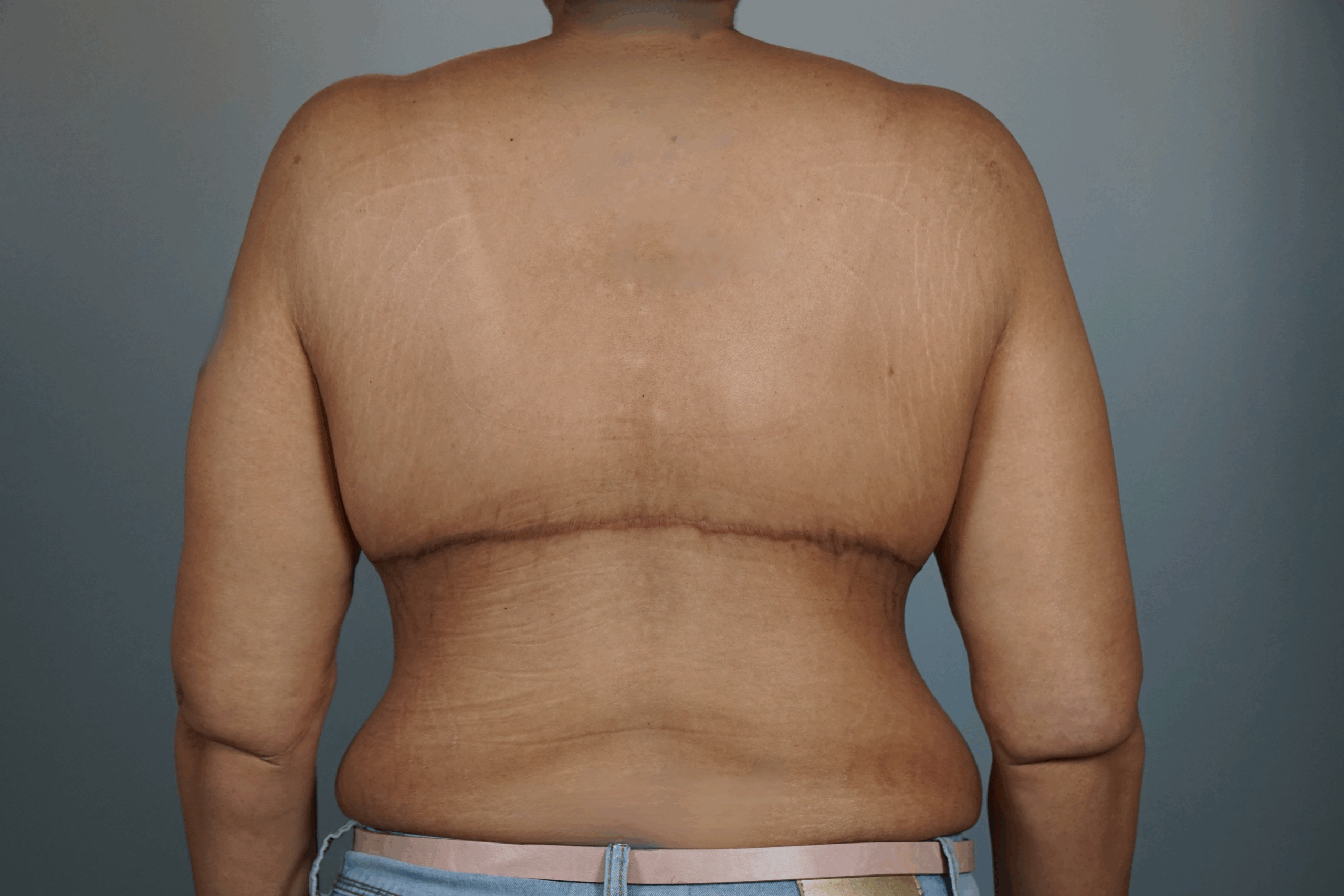 Case #690 After image