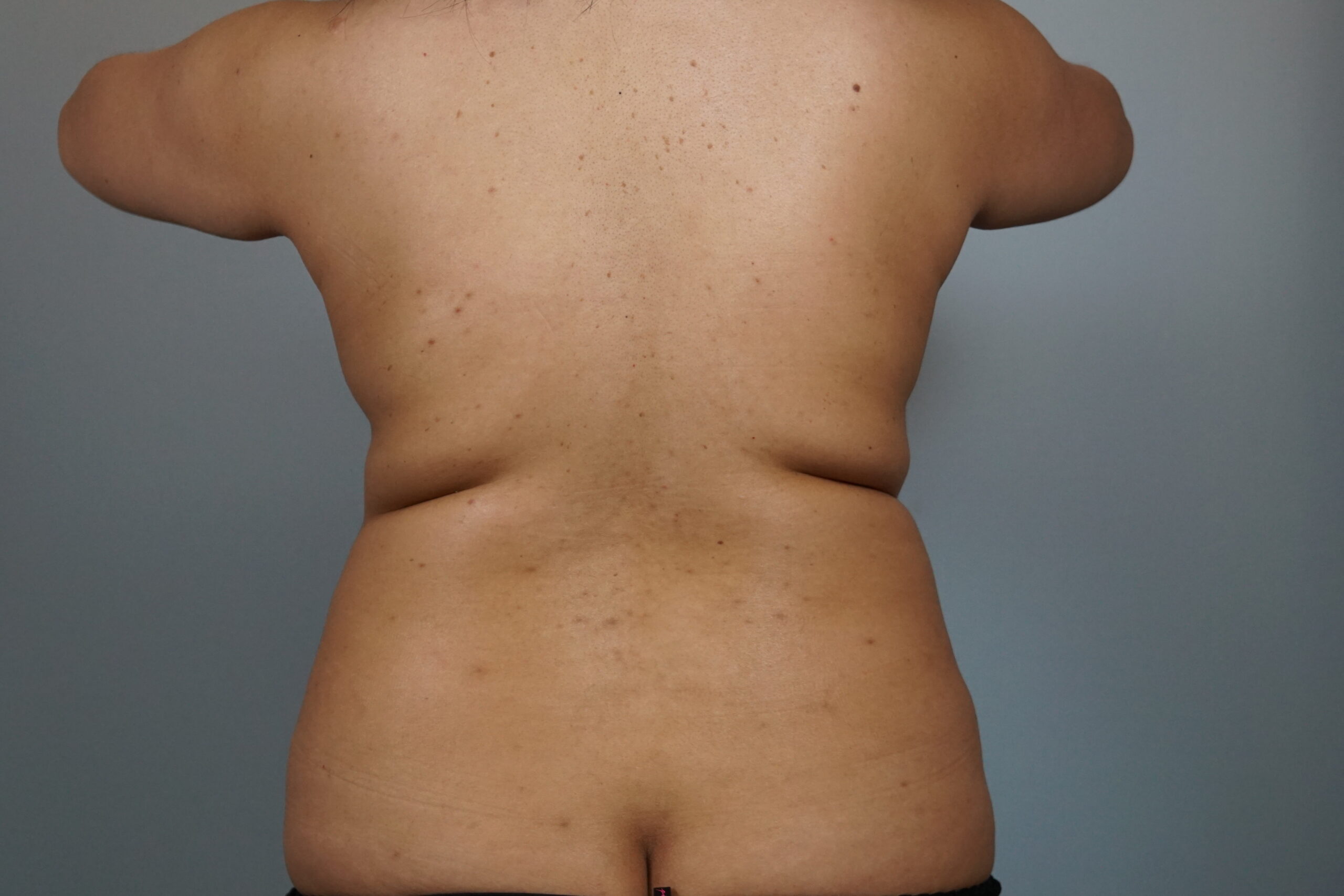 Case #687 Before image