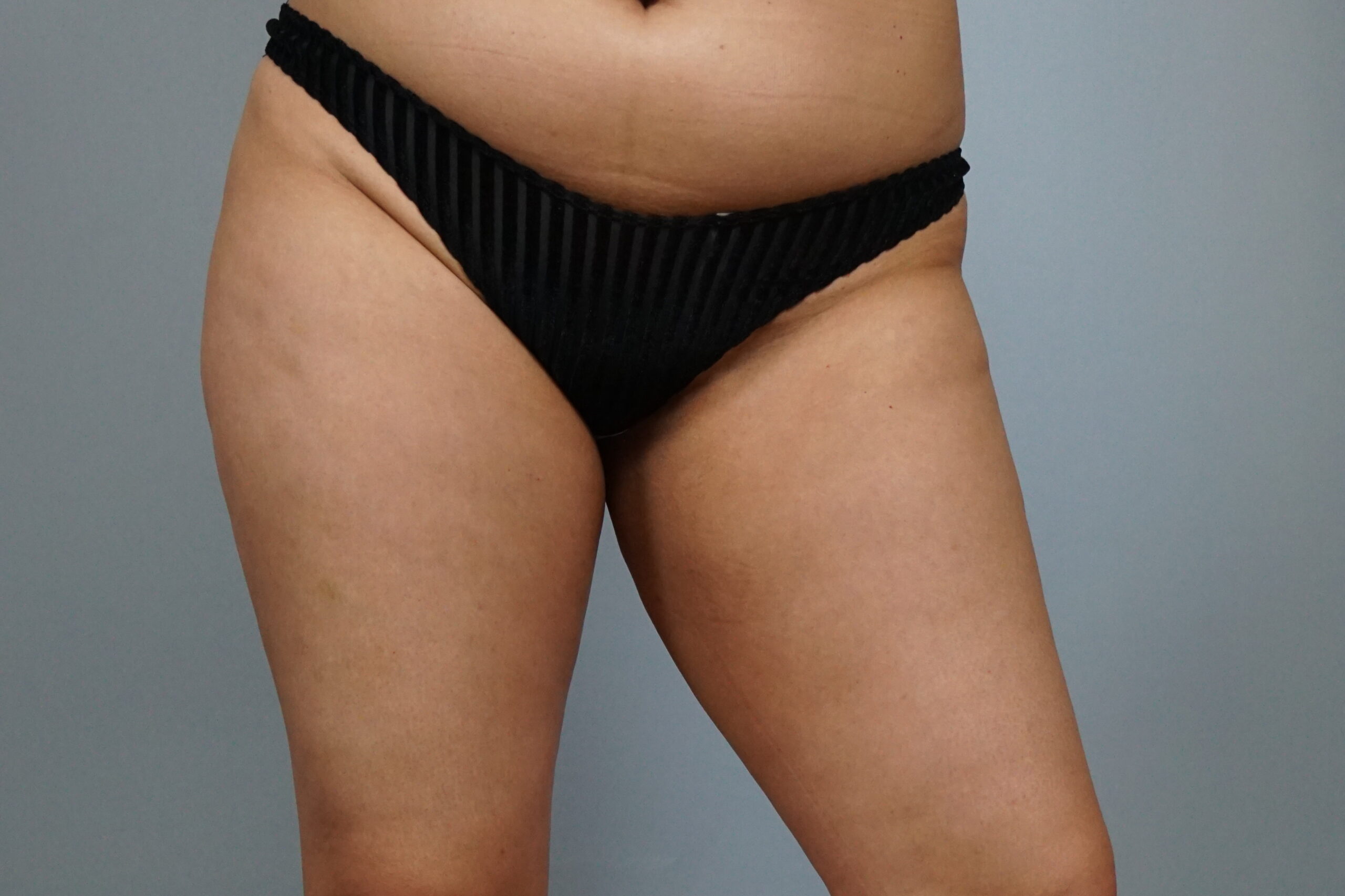 Case #687 Before image