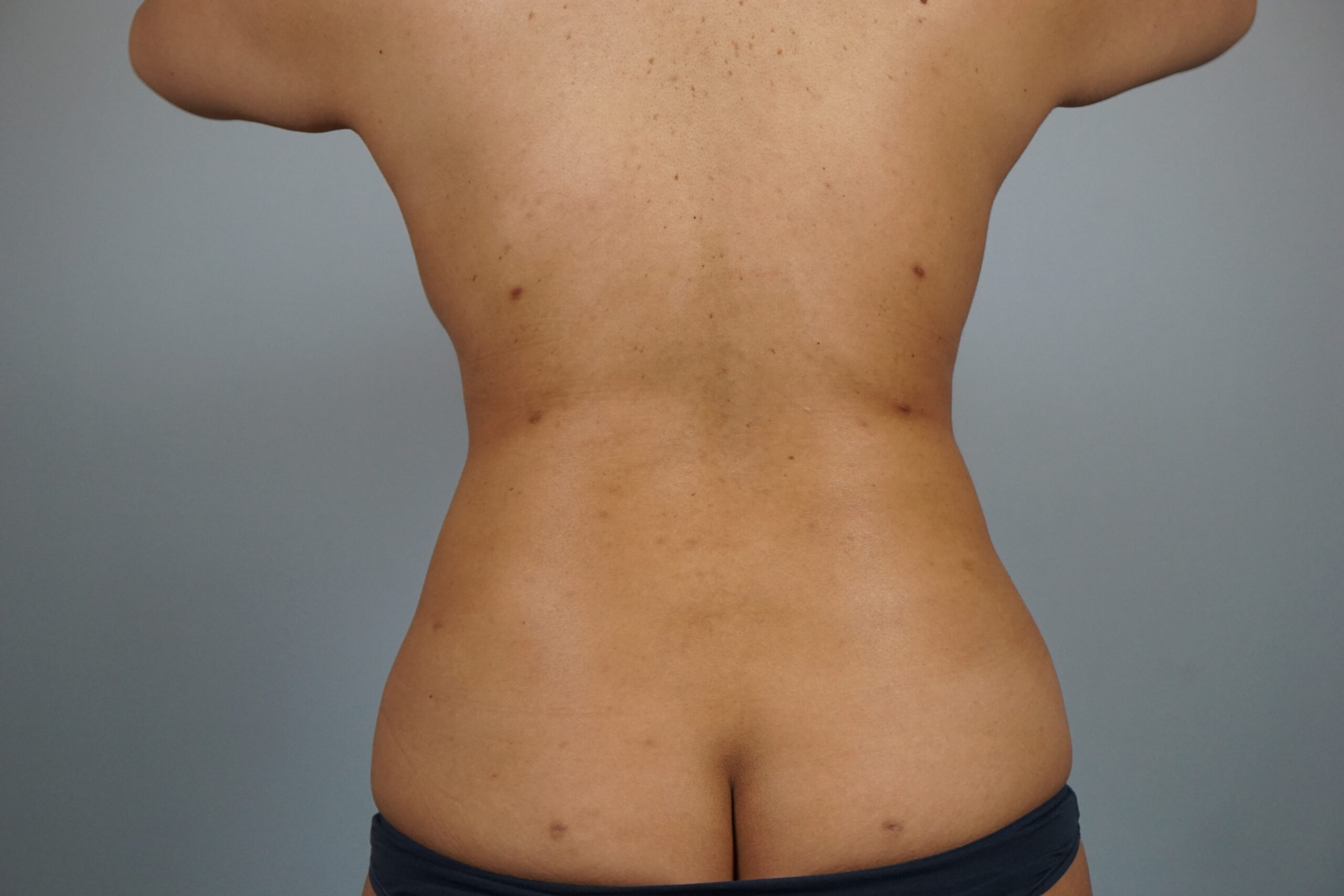 Case #687 After image