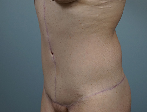 Case #698 After image