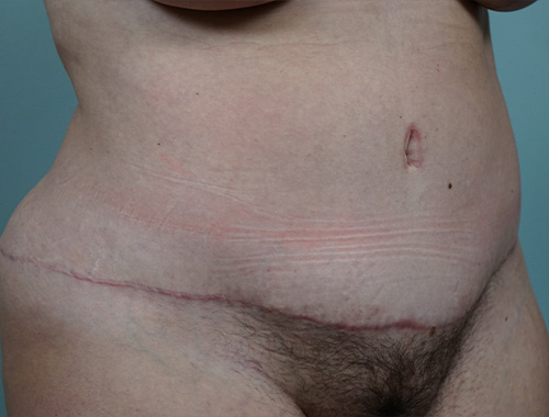 Case #693 After image