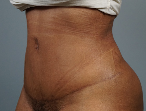 Case #695 After image