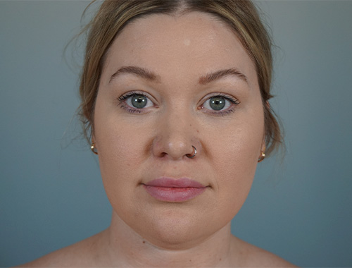 Case #696 Before image