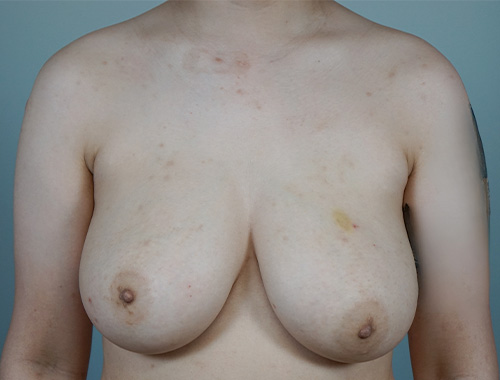 Case #692 Before image