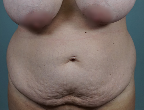 Case #693 Before image