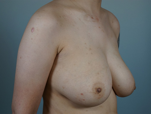 Case #692 Before image