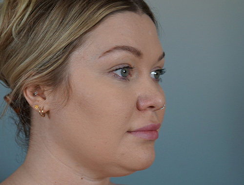 Case #696 Before image