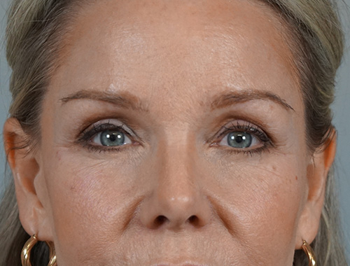 Case #700 After image