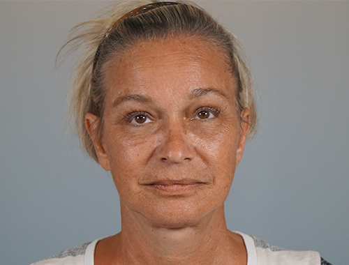 Case #706 After image