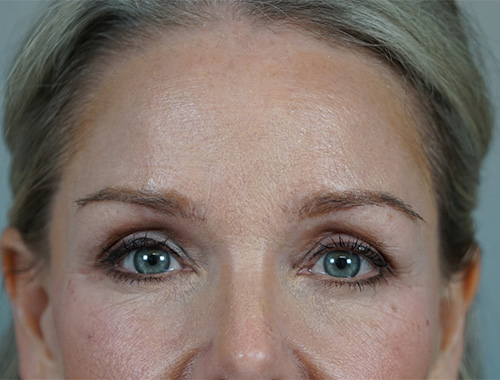 Case #700 After image