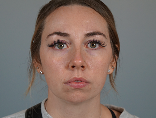 Case #704 Before image