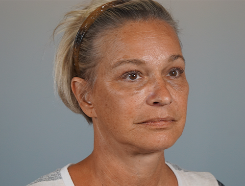 Case #706 After image