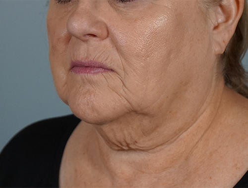 Case #707 Before image