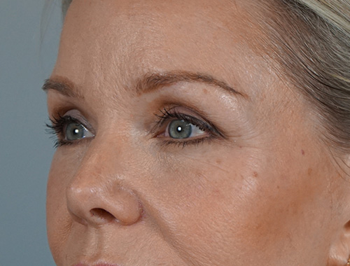 Case #700 After image