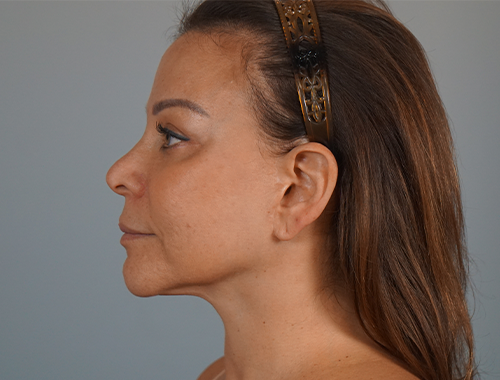 Case #705 After image