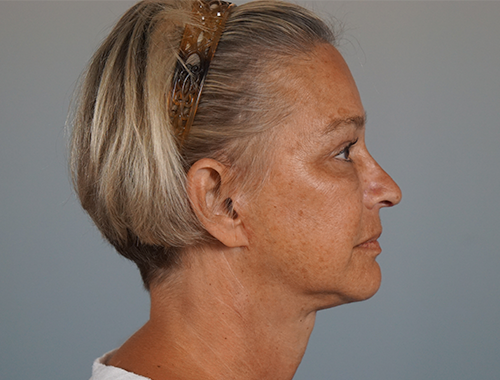 Case #706 After image