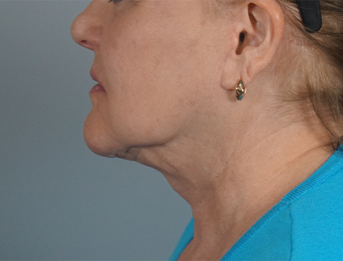 Case #707 After image