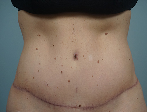 Case #714 After image