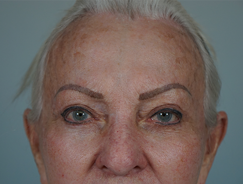 Case #720 After image