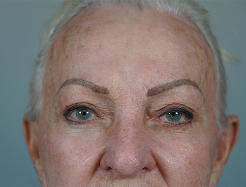 Case #720 Before image