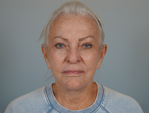 Case #720 After image