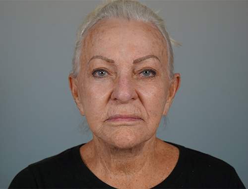 Case #720 Before image