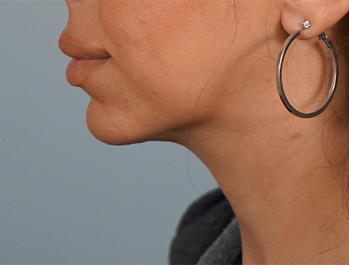 Case #723 After image