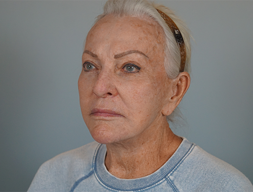 Case #720 After image