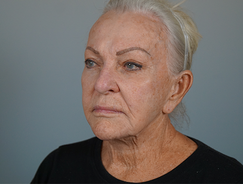 Case #720 Before image