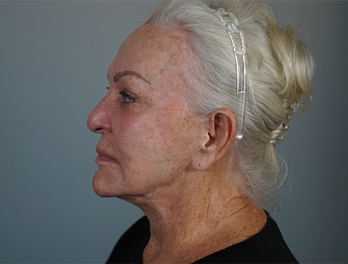 Case #720 Before image