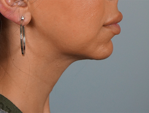 Case #723 After image