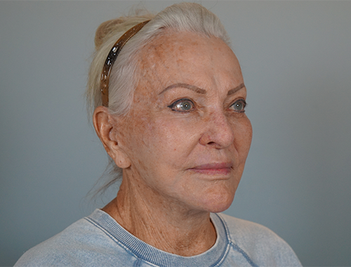 Case #720 After image