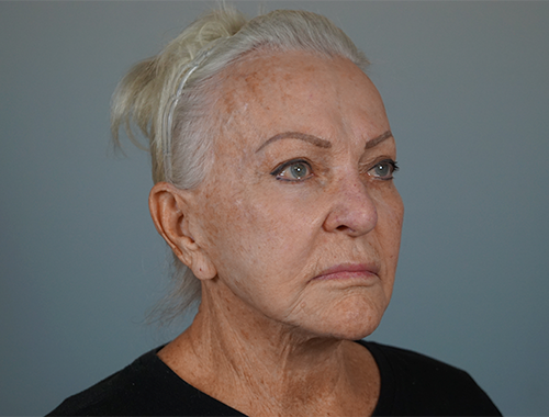 Case #720 Before image