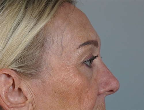 Case #719 After image