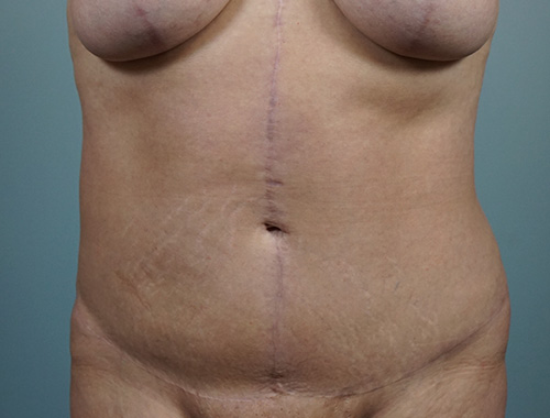 Case #727 After image