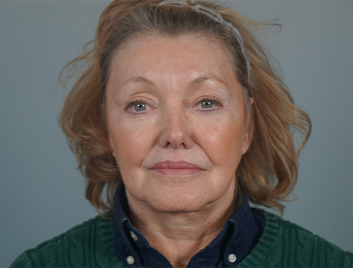 Case #728 After image