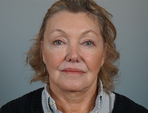 Case #728 Before image