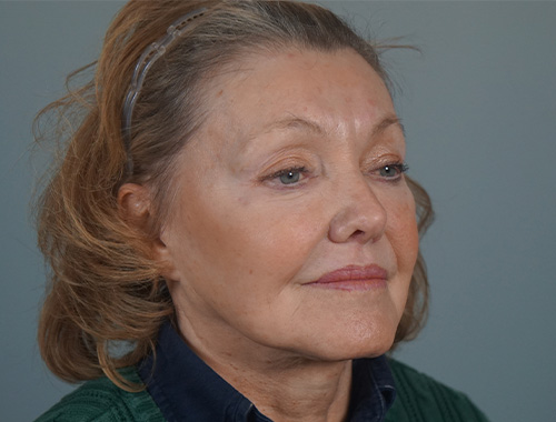 Case #728 After image