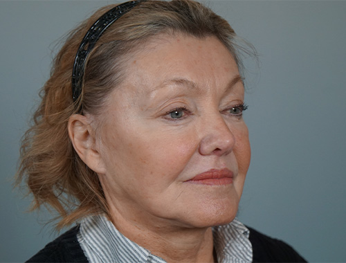 Case #728 Before image