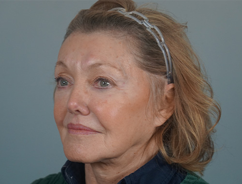 Case #728 After image