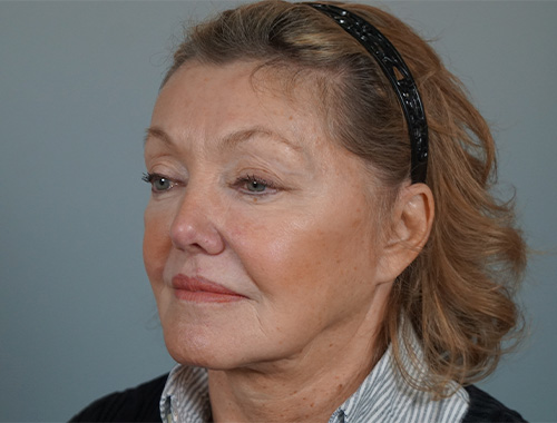 Case #728 Before image