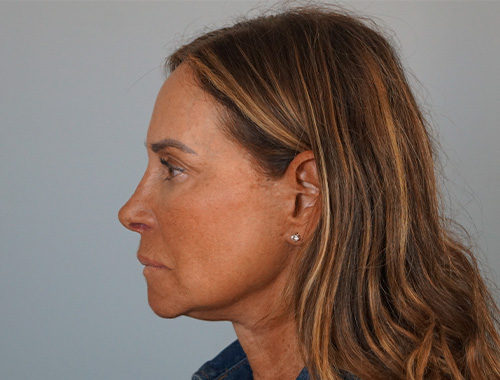 Case #726 After image