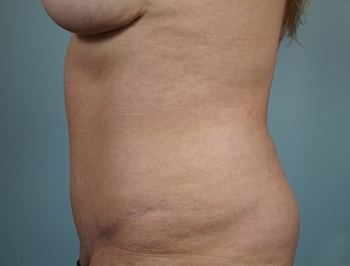 Case #727 After image